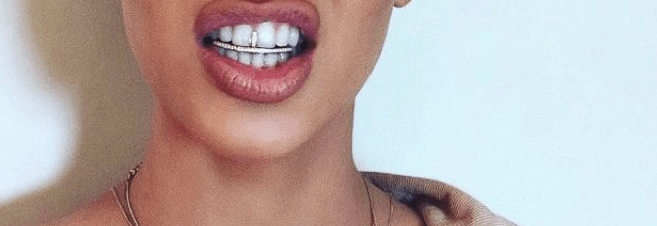 Diastema o la moda de separar los dientes Achutegui dental