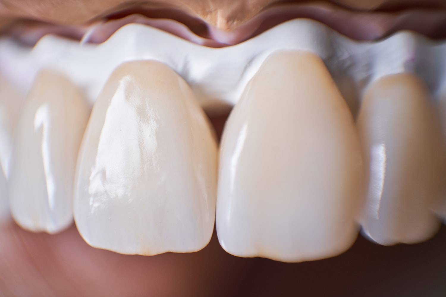 manchas blancas dientes