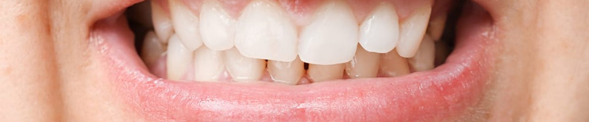 maloclusion dientes